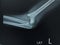 X-ray Left Elbow supracondylar fracture of the humerus with elbow dislocation