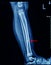 X-ray Left Leg AP Lat fracture Tibia