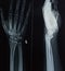 X-ray of left wrist with fracture line on distal radius bone