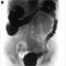 X-ray of the lower parts of the gastrointestinal tract GI. Tight filling. Dolichocolon. Diverticulosis. Negative.