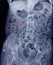 X-ray LS-spine AP view Showing Burst fracture of L2 vertebral body with severe vertebral collapse,Medical image concept