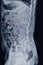 X-ray LS-spine Lateral view Showing Burst fracture of L2 vertebral body with severe vertebral collapse,Medical image concept