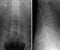X-ray of the lumbar spine. Deforming spondylosis. lateral and sagittal projections.