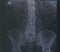 X-ray lumbar spine diagnosis