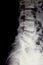 X-ray of the lumbar spine with herniated disc