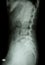 X-ray lumbo-sacral spine (lateral) of asian adult people