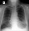 X-ray lung. showing a large infiltrate in the left lung, Pleurisy. Pneumonia.