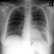 X-ray lung. showing a large infiltrate in the left lung. Pneumonia.