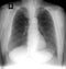 X-ray lung. Volume formation of the mediastinum.