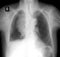 X-ray lung. Volume formation of the mediastinum. Negative.