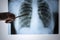 X-ray of the lungs. Chest x-ray. Doctor`s view of the lung image in the hospital on a reflective board, blurred focus
