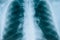 X-ray of lungs, fluorography. Medical scan of the lungs