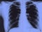 X-ray of the lungs of a healthy person. Female chest x-ray film.