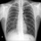 X-ray lungs: lobectomy right lung post tuberculosis