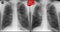 X-ray of the lungs: Operated lung. Escalation tuberculosis of the lungs after 6 months. Negative.