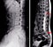 X-ray and MRI Lumbar spine