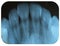 X-Ray Negative Tooth Incisors