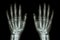 X-ray normal human hands (front)