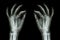 X-ray normal human hands (front) on black background