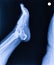 X-ray normal human\\\'s foot lateral