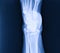 X-ray normal human\\\'s foot lateral