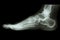 X-ray normal human\'s foot lateral