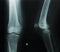 X-ray normal knee