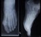 X-ray orthopedics scan of foot injury anterior posterior AP