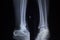 X-ray orthopedics scan of foot injury anterior posterior AP