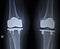 X-ray orthopedics scan of knee meniscus implant prosthetics