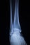 X-ray orthopedics scan of painful ankle foot injury