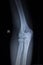 X-ray orthopedics Traumatology scan of elbow joint injury