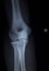 X-ray orthopedics Traumatology scan of elbow joint injury