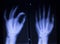 X-ray orthopedics Traumatology scan of hand finger injury