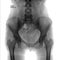 X-ray of the pelvis and the lumbosacral spine. Spina bifida S1. Negative. Marker.