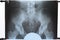 X-ray of the pelvis and sacrum. X-ray