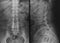 X-ray of pelvis and spinal column