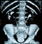 X-ray of the pelvis and spinal column