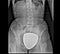 X-ray of the pelvis and spinal column, front view