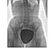 X-ray of the pelvis and spinal column, front view