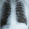 X-ray photo of a human adult chest with infected lungs