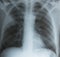 X-ray photo of a human adult chest with infected lungs with Covid-19