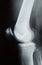 X-ray photo of a human knee