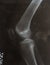 X-ray photo of a human leg with dislocated knee cap