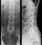 x-ray photo of human lumbar spine, front and side view