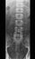 x-ray photo of human lumbar spine, front view