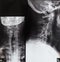 X-ray photo of a human necks with fractured spines