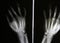 X-ray photos of bone fracture patients