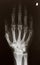 X-ray picture of hand