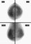 X-ray picture Mammography. Small calcinates. Ð¡ancer. Negative.